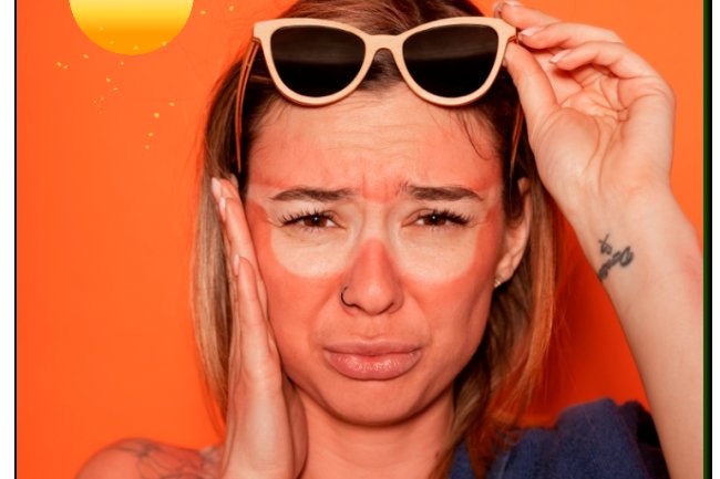 Uncovering & Exploring the Natural Home Remedies for Sunburn