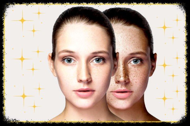  Freckles' Causes and Treatments; why do we get freckles & how to treat These freckles
