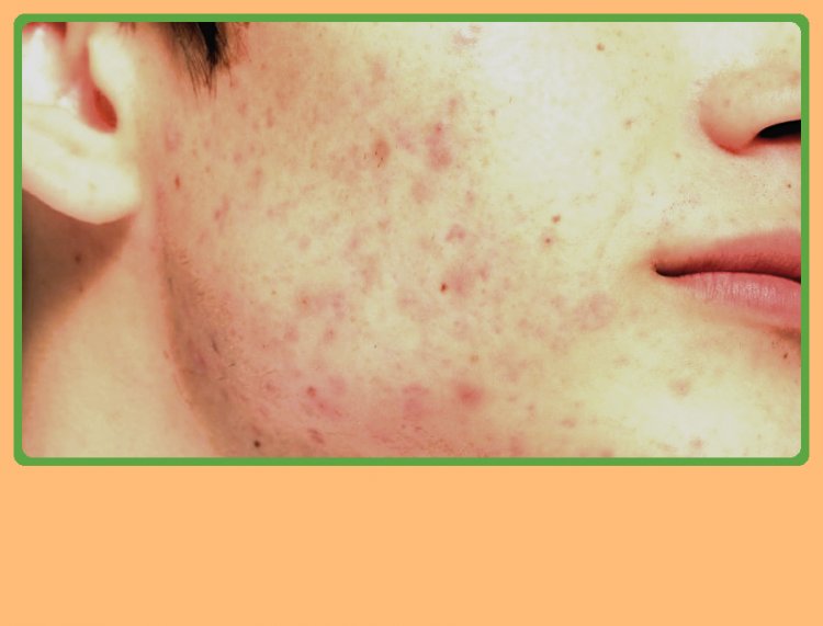 Crafting Your Skin's Destiny to Get Ageless Beauty; Remarkable Home Remedies to Brighten Pigmented Skin