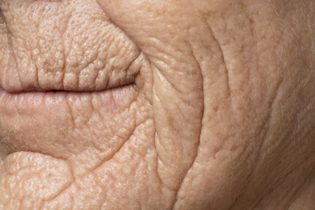  The Ultimate Guide of Natural Remedies for Wrinkles and Sagging Skin: Best Home Remedies for Anti-Aging