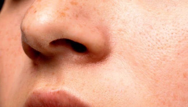 Explore The Organic Home Remedies for Large Open Skin Pores