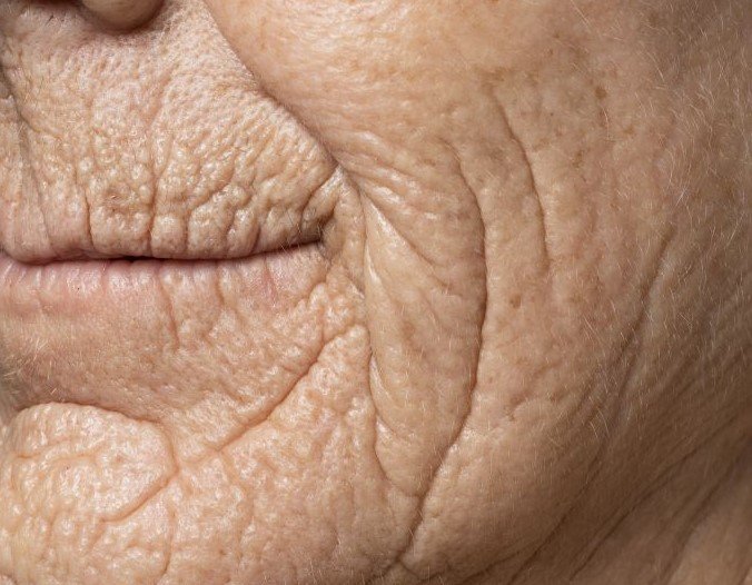  The Ultimate Guide of Natural Remedies for Wrinkles and Sagging Skin: Best Home Remedies for Anti-Aging