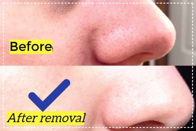 Black and Whitehead Treatments: Top Home Remedies to Remove Blackheads and Whiteheads