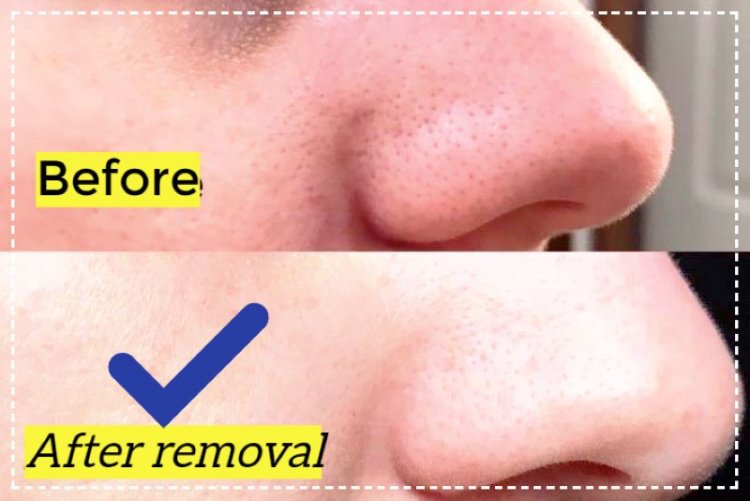 Black and Whitehead Treatments: Top Home Remedies to Remove Blackheads and Whiteheads